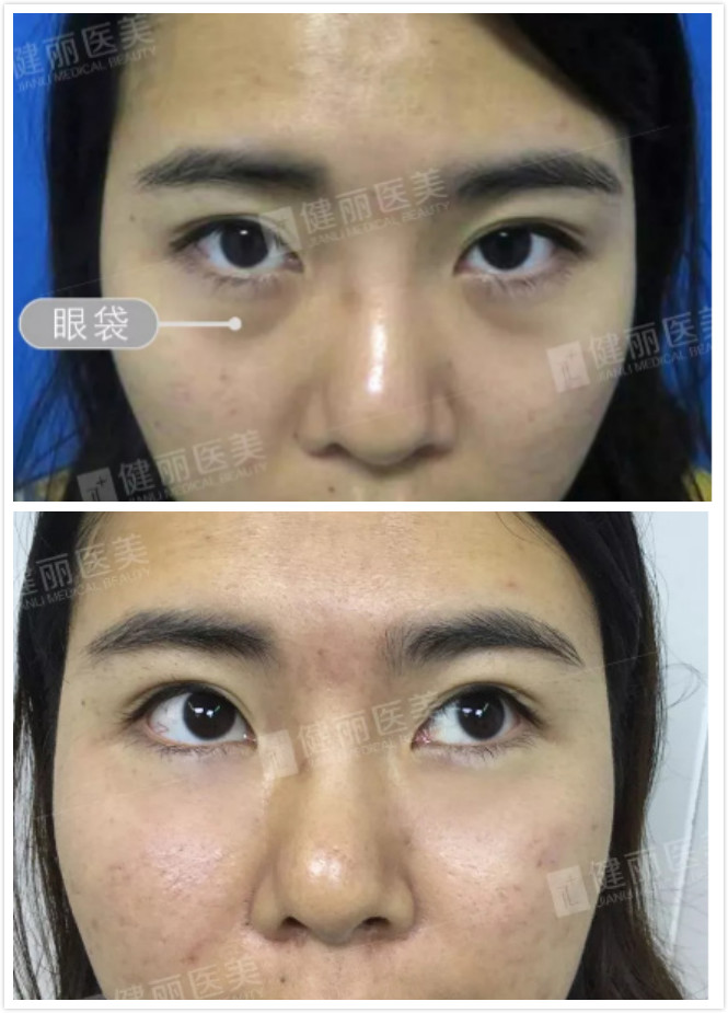 眼袋案例3
